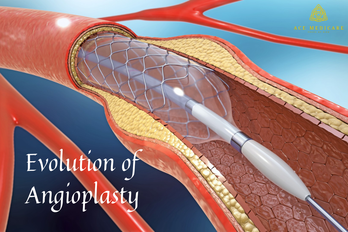 The Evolution of Angioplasty: From Concept to Lifesaving Procedure